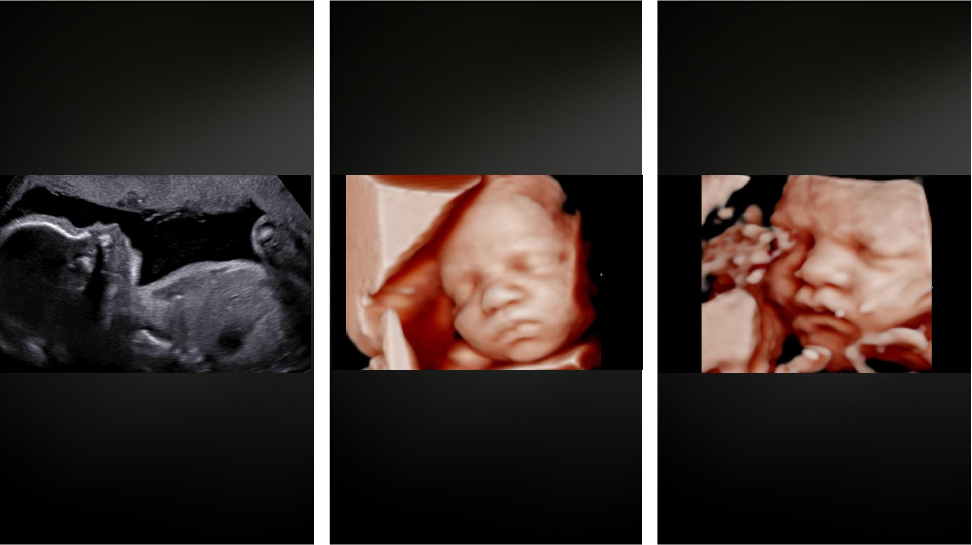 Ultrasound image