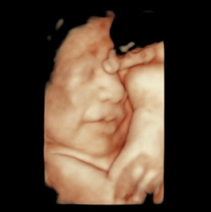 Ultrasound image
