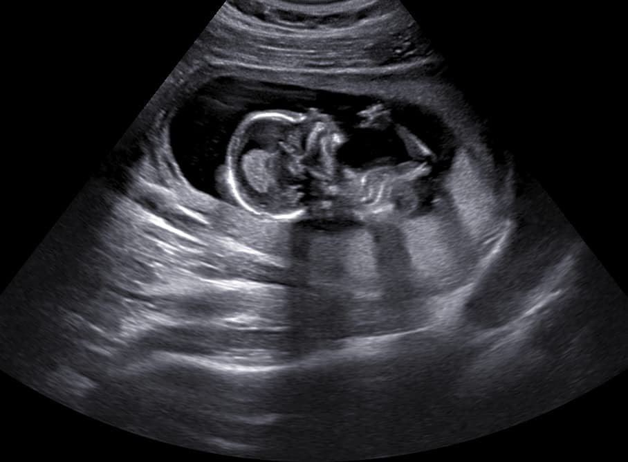 Ultrasound image