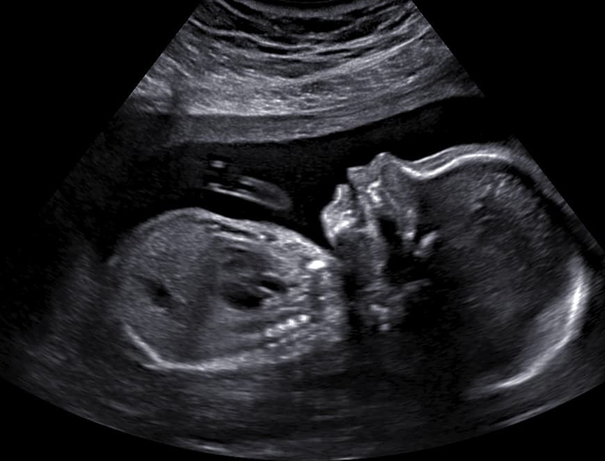 Ultrasound image