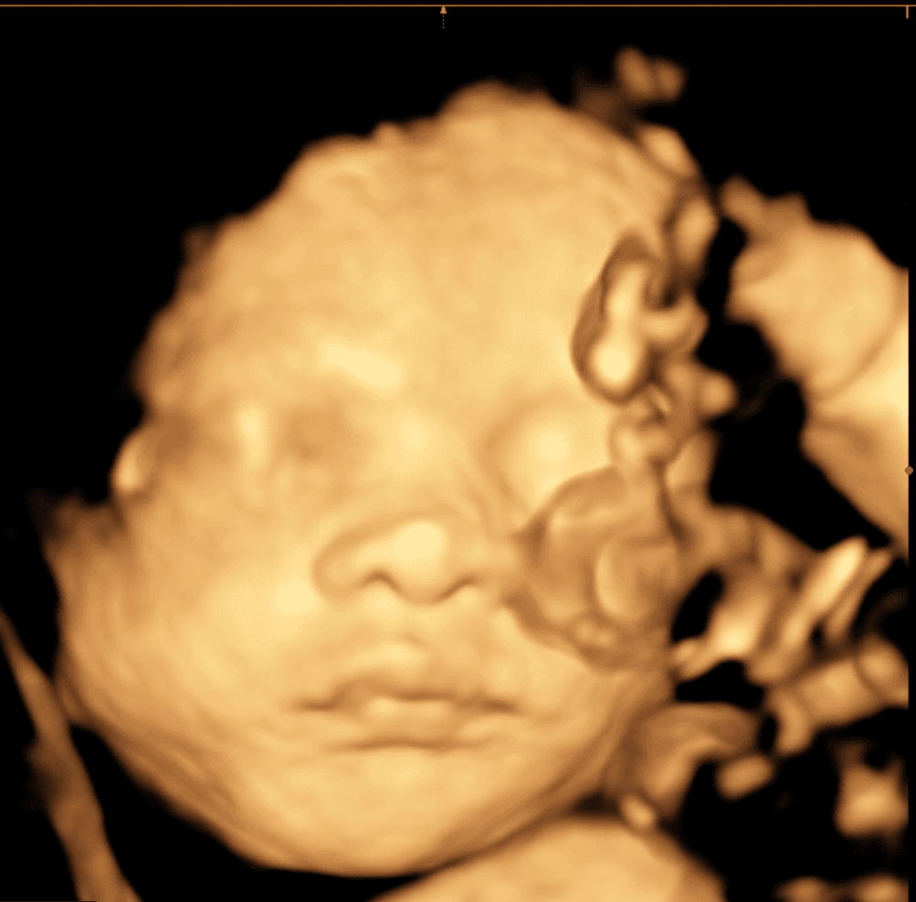 Ultrasound image