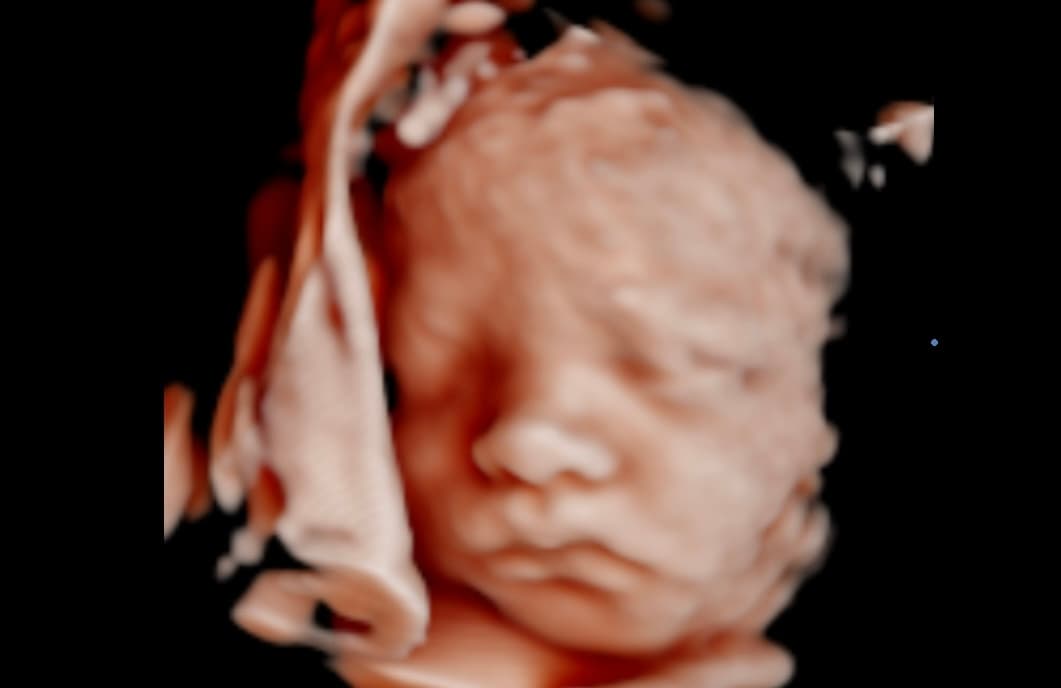 Ultrasound image