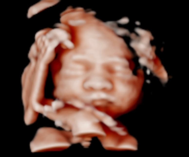 Ultrasound image